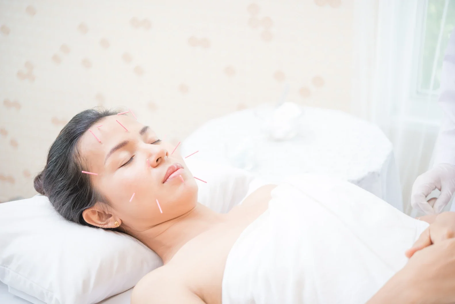 A woman undergoes a facial acupuncture session, lying peacefully on a treatment table with fine needles placed on her face, highlighting a traditional approach to enhancing skin health and relaxation.