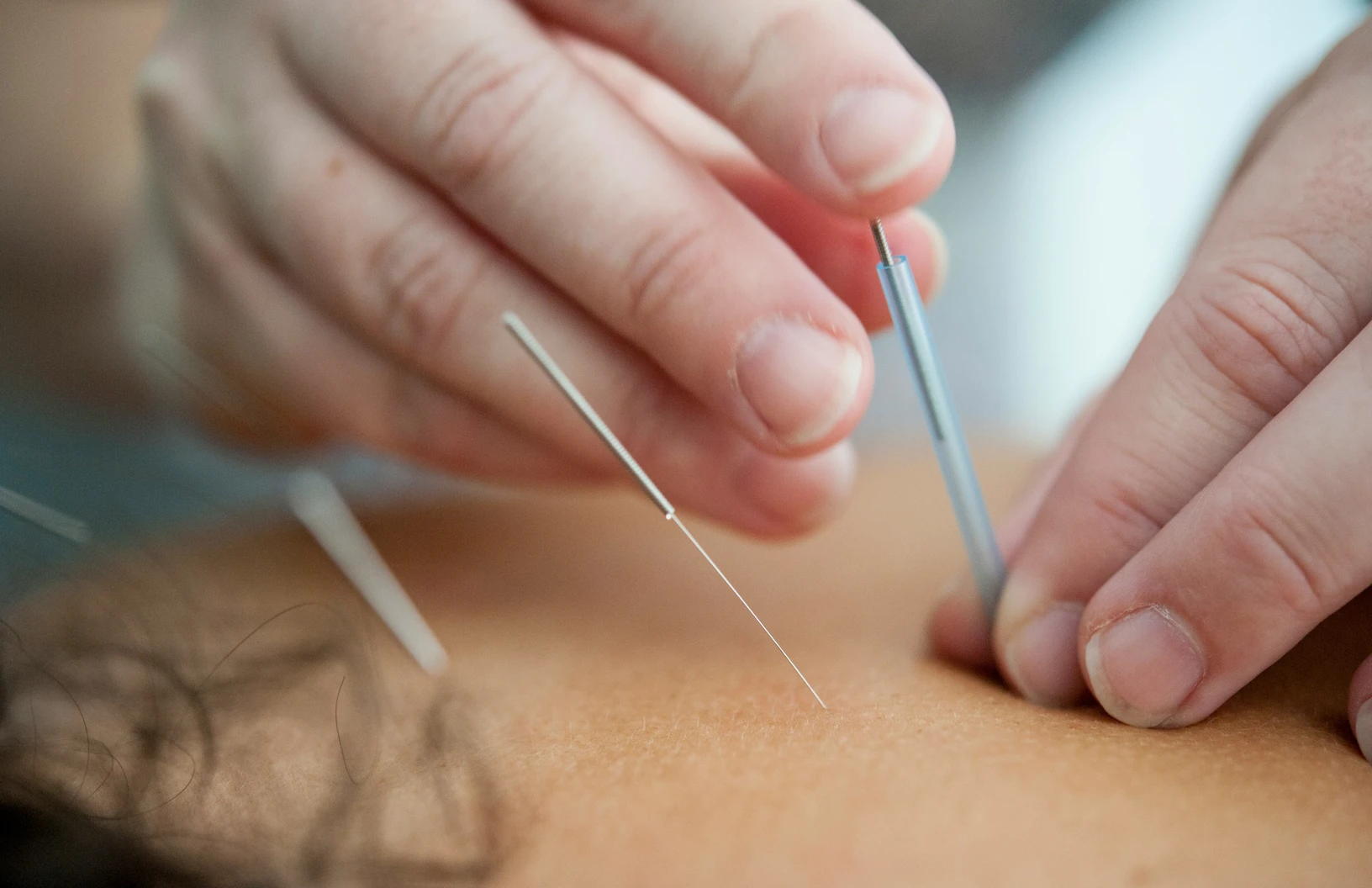 Rejuvenating Your Skin with Facial Acupuncture – Part 2