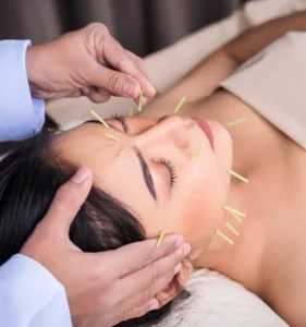Facial Acupuncture