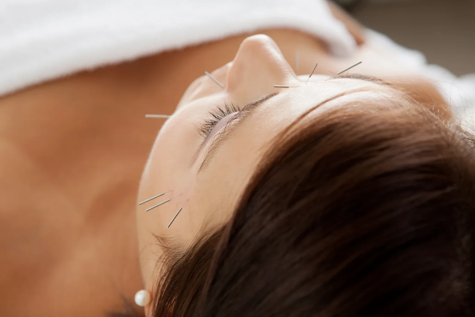 Discover the Secret to Radiant Skin with Facial Acupuncture