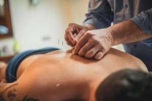 acupuncture